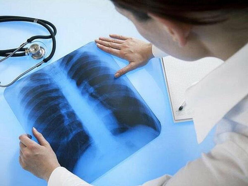 Ağciyər xərçəngi riskini artıran 