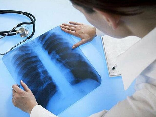 Ağciyər xərçəngi riskini artıran 