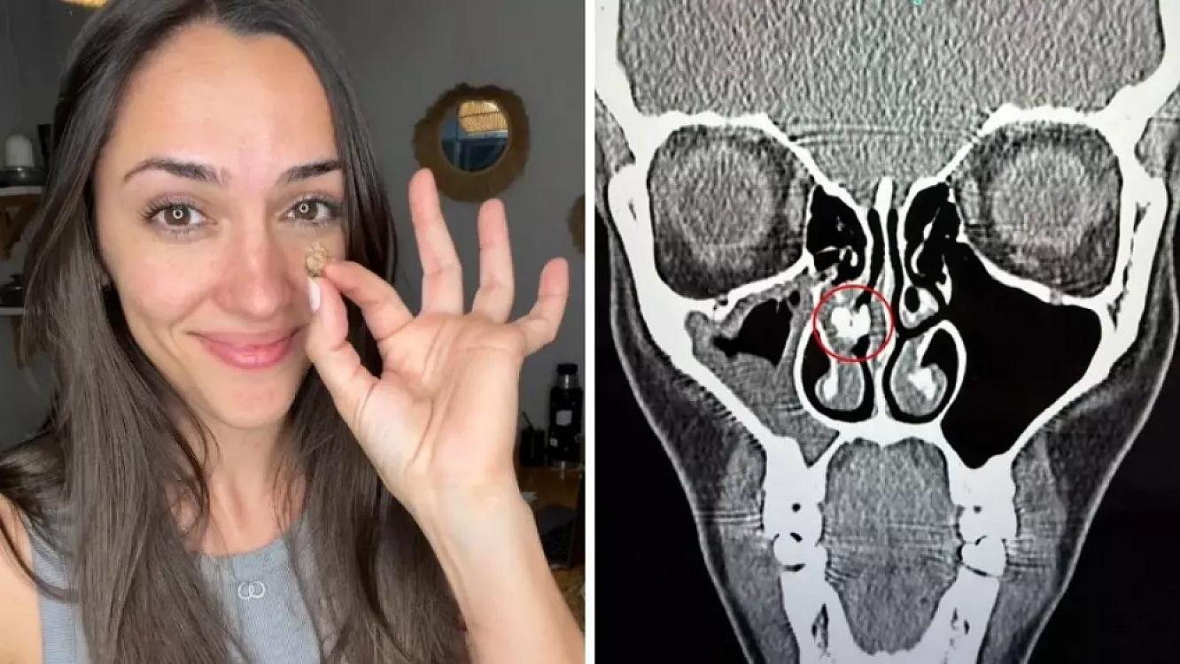 Qadının burnundan görün nə çıxdı - 