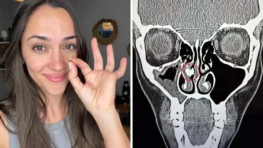 Qadının burnundan görün nə çıxdı - 