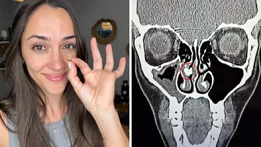 Qadının burnundan görün nə çıxdı - 