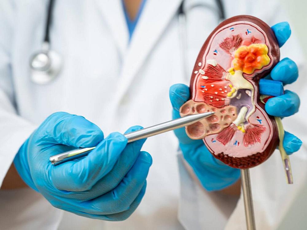 Böyrək daşlarının yaranmasına səbəb olan qidalar 