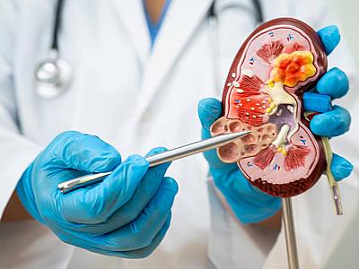 Böyrək daşlarının yaranmasına səbəb olan qidalar 