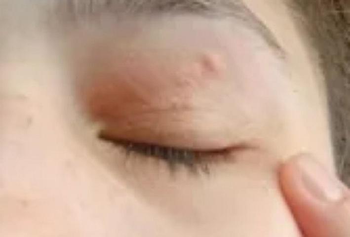 Bir ay gözündə 11 santimetrlik qurdla gəzdi - 