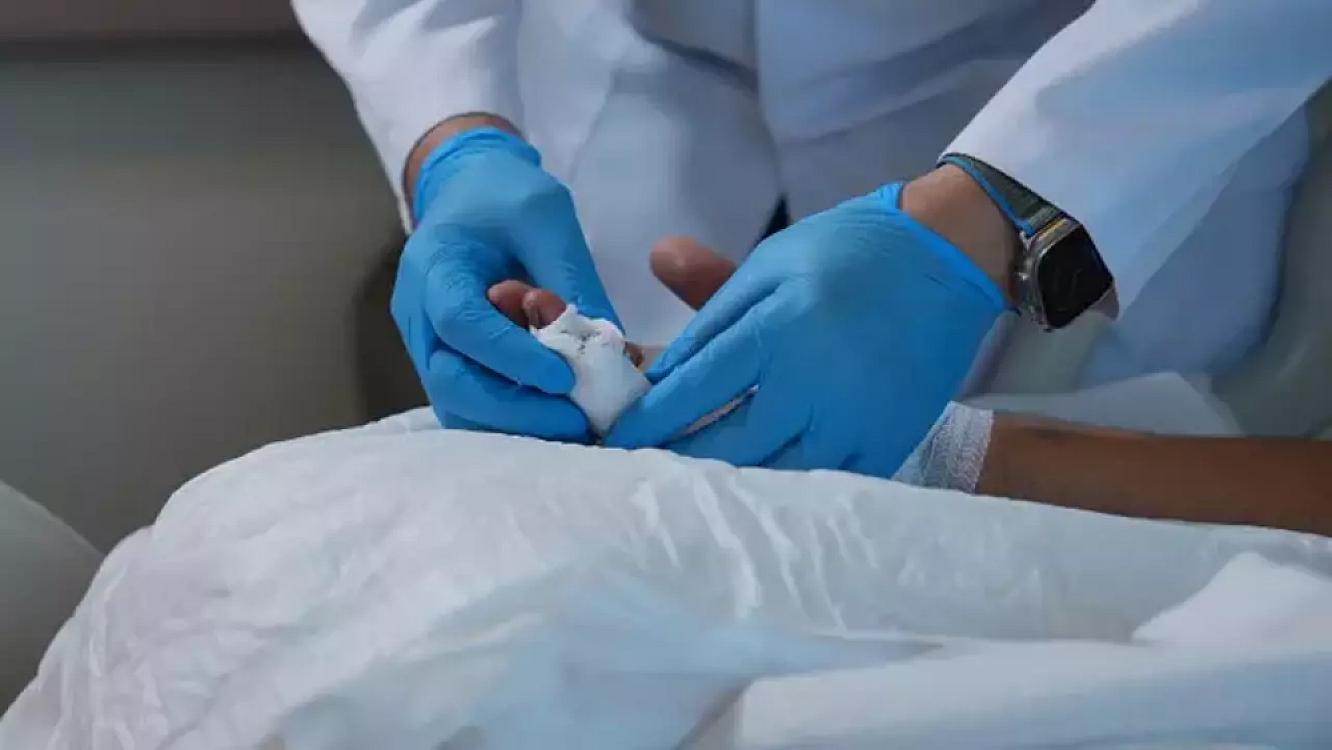 The severed finger was reattached using microsurgical technique - PHOTO