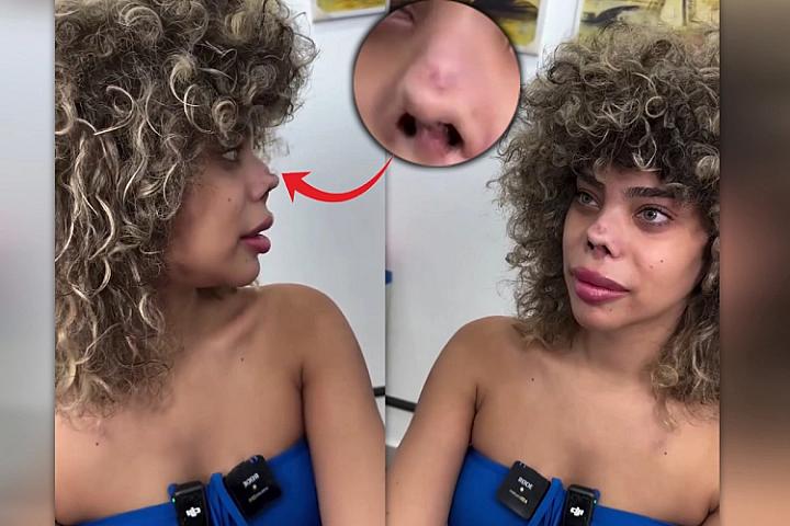 Türkiyədə plastik əməliyyat olunan qadın burnunun yarısını itirdi - 