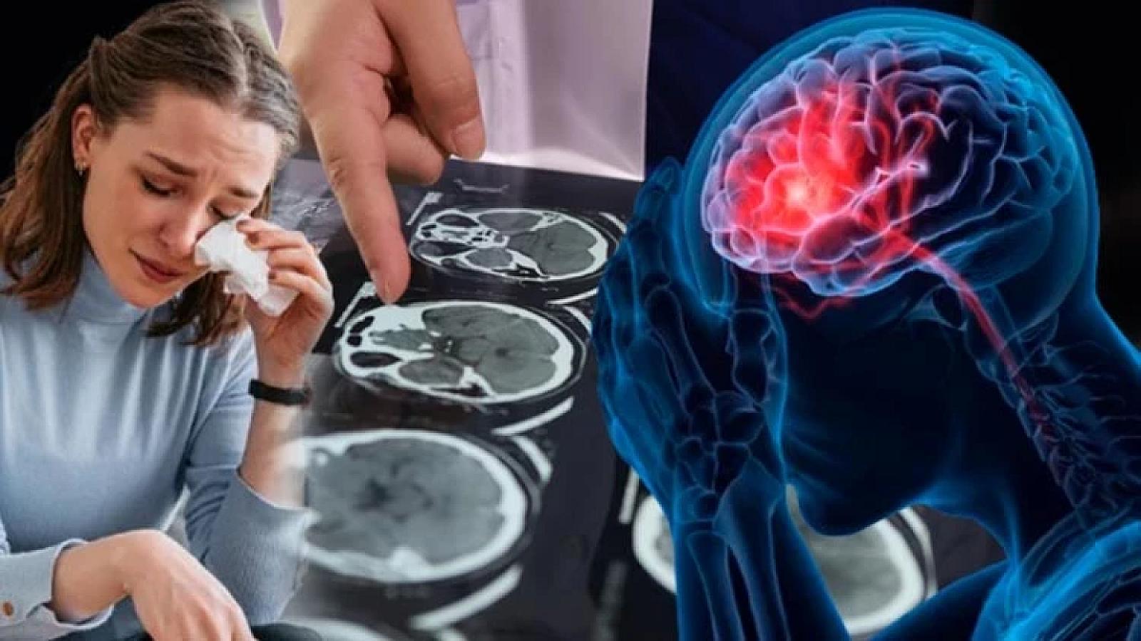 Beyin qanaması riski 20 yaşa qədər 