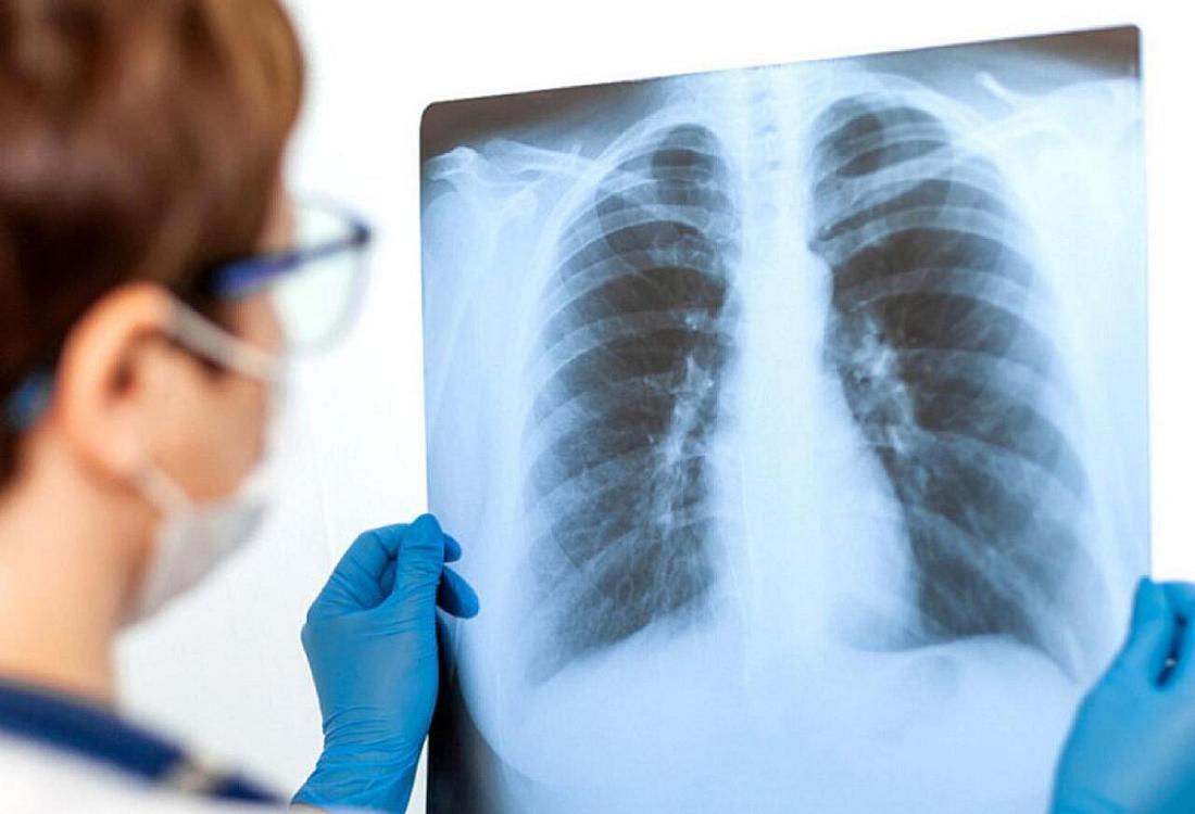 Məktəblilər arasında pnevmoniya sürətlə yayılır - 