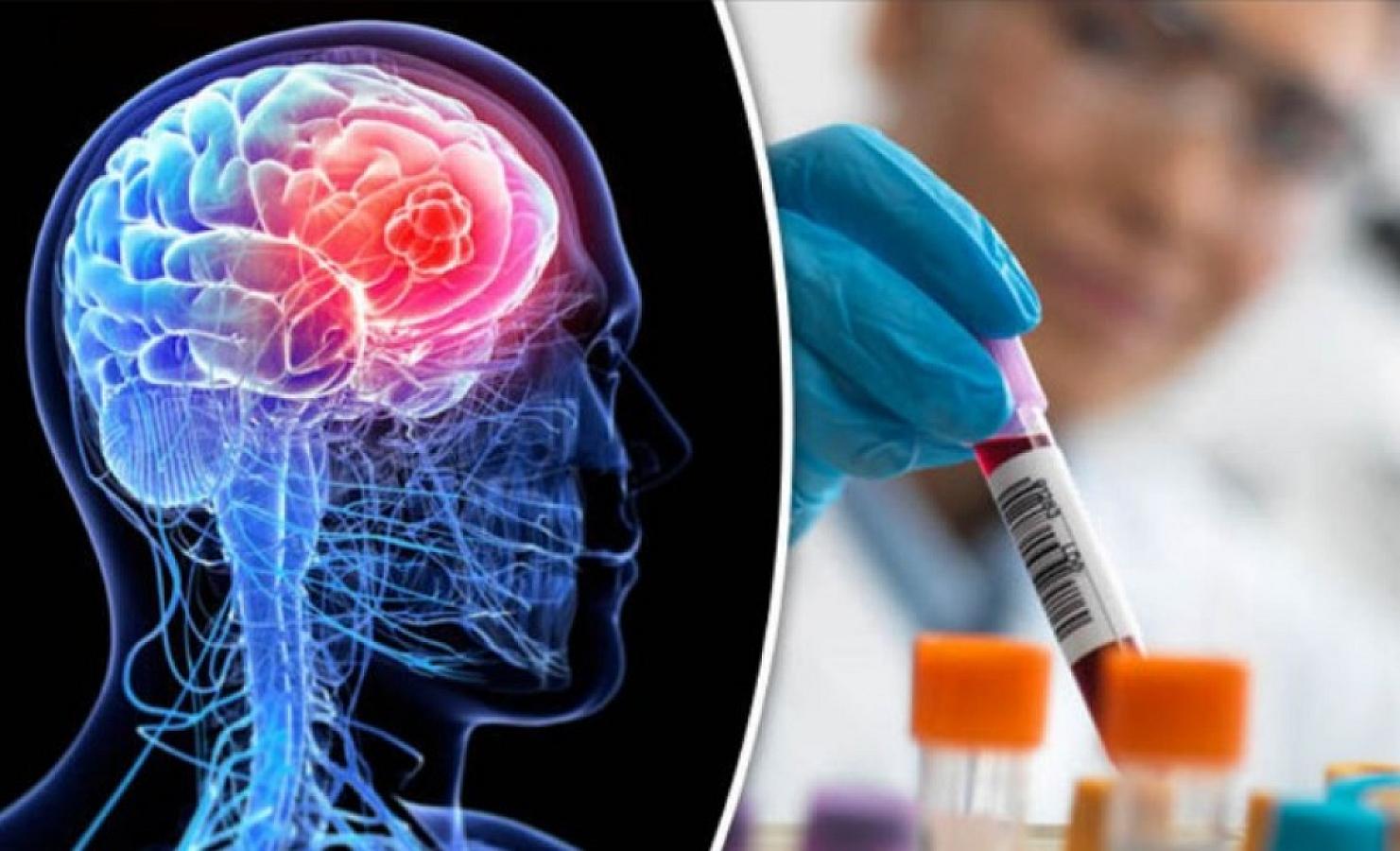 Bu, beyin xərçənginə 