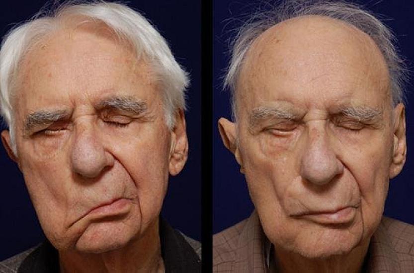 Üst siniri iflici necə müalicə olunur?