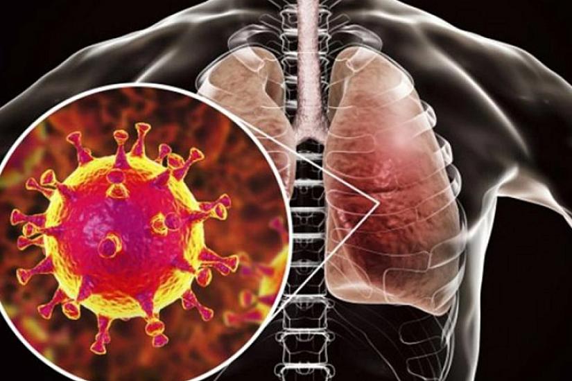 Pnevmoniya sürətlə yayılır? -