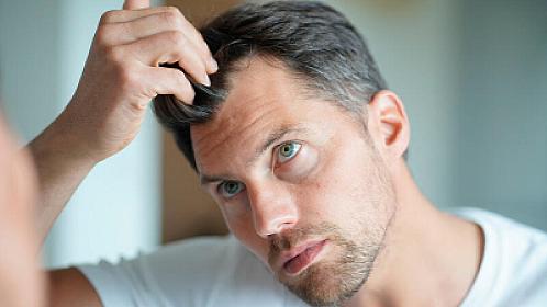 Kişilərdə 30 yaşına çatmadan saçları niyə tökülür?