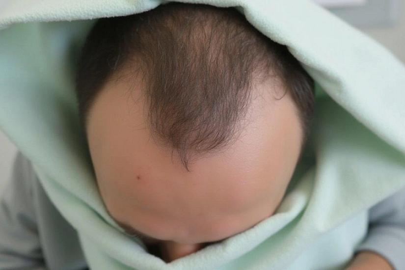 Saç əkimi zamanı faciə: 