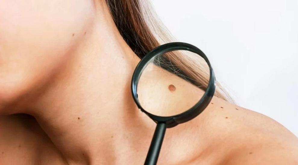 Dəridəki təhlükəli xallarla bağlı rusiyalı onkoloqdan 