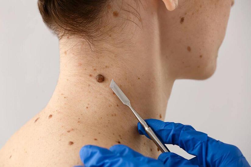 Когда родинки на коже опасны? - Объяснение онколога