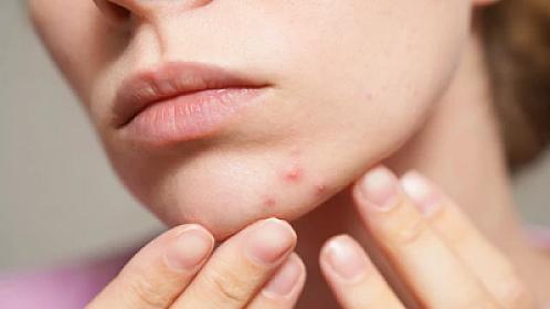 Sızanaqlara qarşı təbii üsul: 