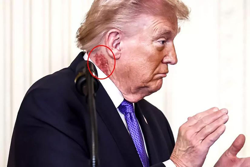 The redness on Trump's neck sparked a discussion –