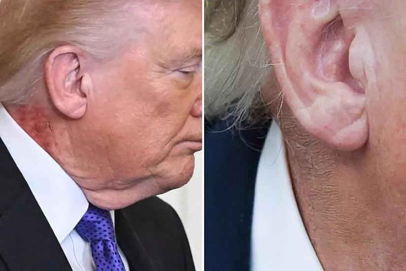 Trampın boynundakı qızartı yenidən diqqət çəkdi – 