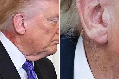 Trampın boynundakı qızartı yenidən diqqət çəkdi – 