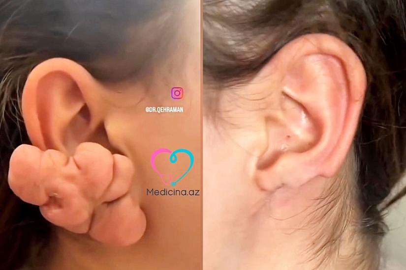 Sırğadan sonra qulağı bu hala düşdü - 