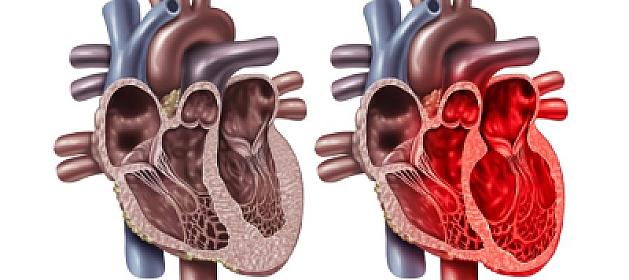 “Qırıq ürək sindromu”: