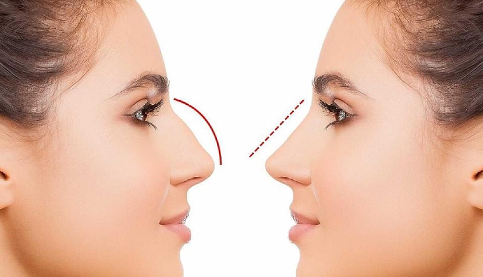 Azərbaycanda bu şəxslərə burun əməliyyatı pulsuz 