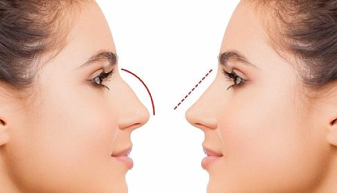 Azərbaycanda bu şəxslərə burun əməliyyatı pulsuz 