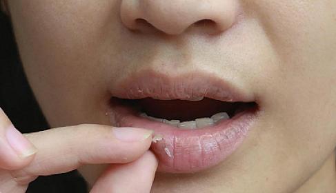 Dodaqların tez-tez quruması 