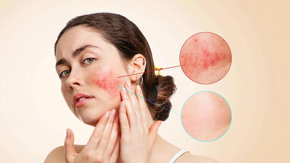 Redness and burning on the skin may be a symptom of this disease -