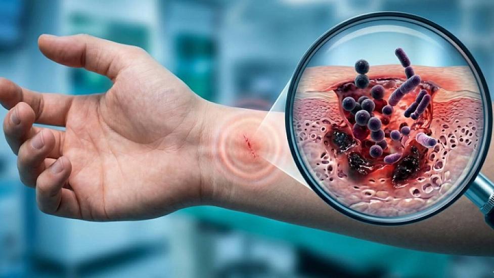 "Meat-eating bacteria" -