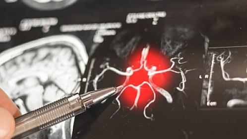 Alzheimer xəstəliyində “gizli mərhələ” aşkar edilib:
