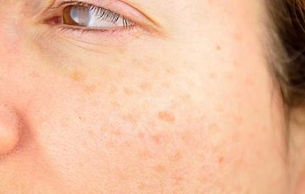 The cause of the formation of spots on the skin