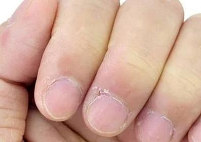 The skin around the nail peels off because of this.