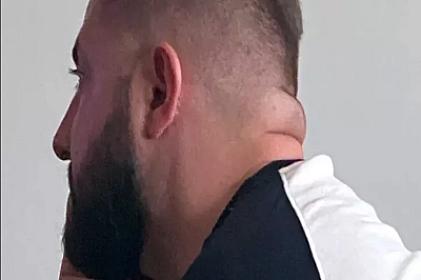 Boynunuzun qalın olması insult və diabet