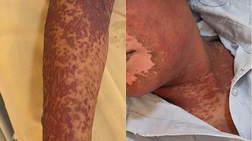Qida allergiyası necə özünü göstərir? - 