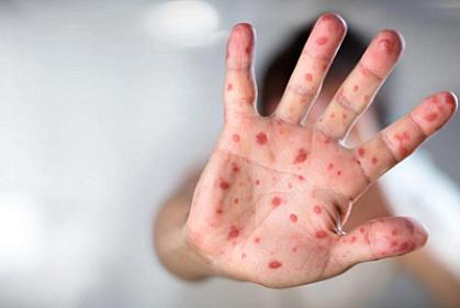 Hazırda Azərbaycanda qızılca və suçiçəyi ilə bağlı epidemioloji vəziyyət sabitdir - 