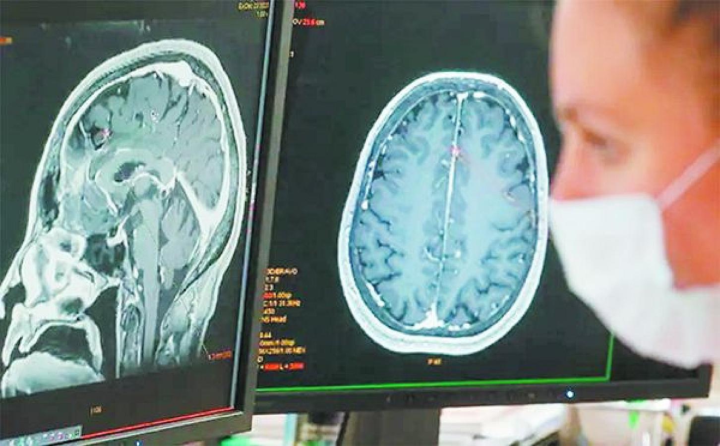 COVİD-19-un beyində qalan fəsadları