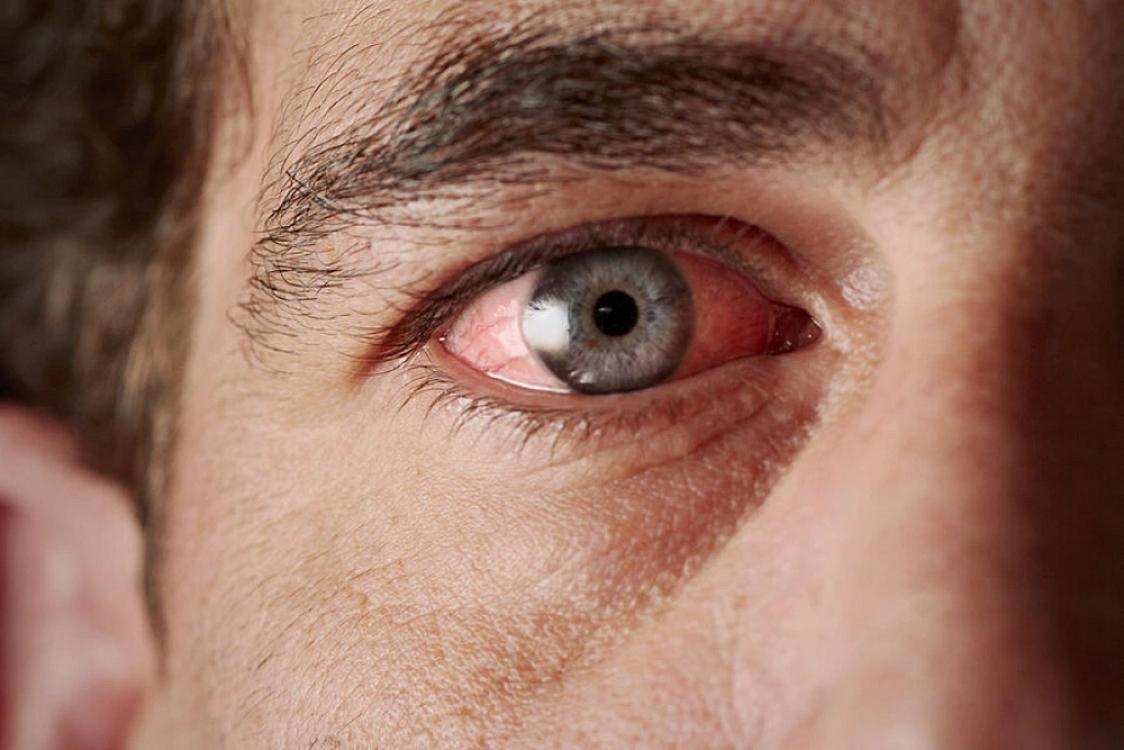 Yaşlı insanlarda gözlərin sulanmasının üç əsas 