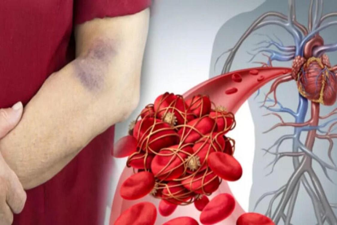 This can save your life: 5 signs of blood clotting