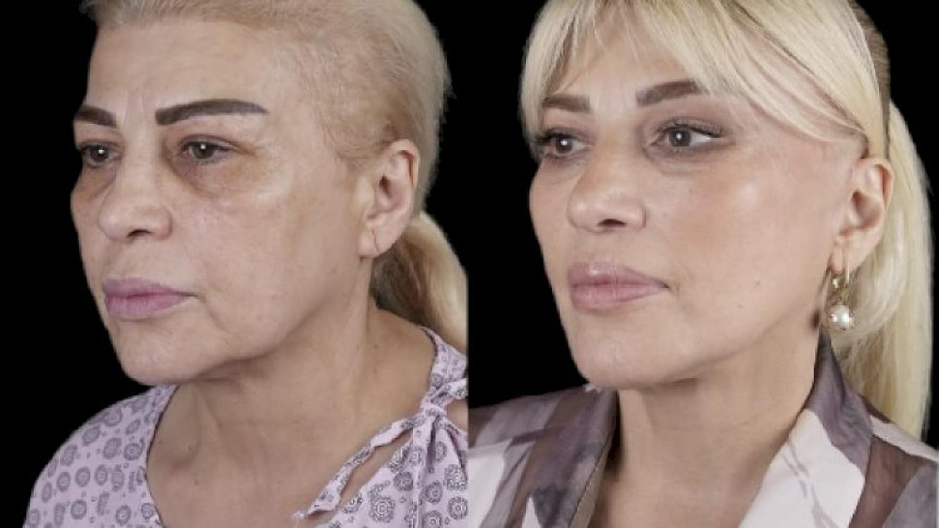 Mətanət İsgəndərli yeni əməliyyatdan sonra - 