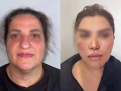 60 yaşlı qadını əməliyyatla bu hala saldılar - 